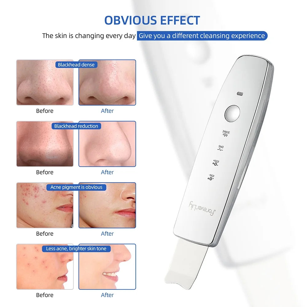 Ultrasound Facial Scrubber Shovel ION LED Light Face EMS Facial Peeling Pore Clean Removal Blackhead Cleansing Skin Care Tool