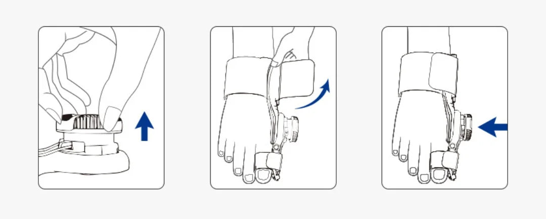 Adjustable Knob Bunion Corrector and Big Toe Alignment Splint