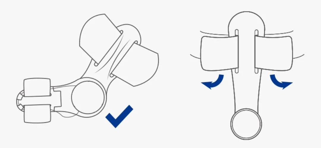 Adjustable Knob Bunion Corrector and Big Toe Alignment Splint